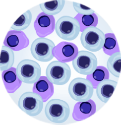 Level of Tumour Burden in bone marrow shown in petri dish with normal and malignant cells- PR.