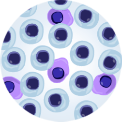 Level of Tumour Burden in bone marrow shown in petri dish with normal and malignant cells- VGPR.