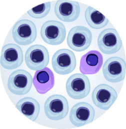 Level of Tumour Burden in bone marrow shown in petri dish with normal and malignant cells- CR.