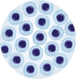 Level of Tumour Burden in bone marrow shown in petri dish with normal and malignant cells- MRD negative.